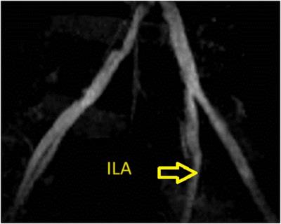 Endovascular intervention with intravascular ultrasound guidance of very early dissection complication in transplant renal artery: a case report and literature review